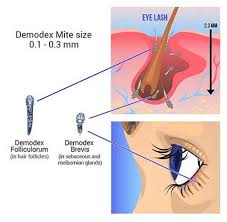 Image result for Demodex folliculorum