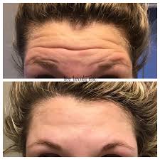 It's always best to make sure and double check with dr. Botox Before And After My Botox Experience