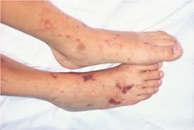 At initial stages, bruises are seen purplish red. Purpura And Other Hematovascular Disorders Sciencedirect