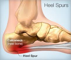 These top of foot bone lumps happen when the foot flattens exceedingly and these bones are compressed. Heel Spur Causes Symptoms Treatments And Surgery