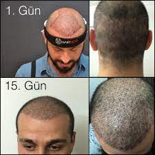 Sevgili Erhan In 1 Ve 15 Gun Kontrolu Hastamiz Cok Mutlu Http Www Hairneva Com Hairneva Sacekimi Fulyaacibadem Sacekimme Dogal Sac Sac Terapi