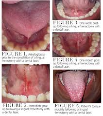Image result for Ankyloglossia