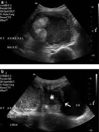 Urinary Bladder Dermoid Cyst Ultrasound Diagnostic Medical Sonography Sonography
