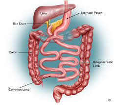 The large intestine is made up of the cecum, the ascending (right) colon, the transverse (across) colon. Biliopancreatic Diversion With Duodenal Switch Advanced Surgeons