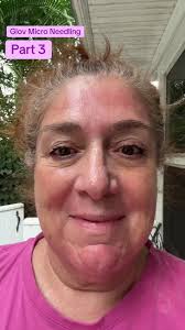 Glov Microneedle Hair Honest Review