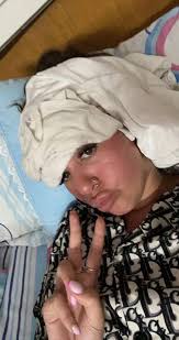 Woman left 'looking like tomato' and thought face would 'explode' after  sleeping in sun