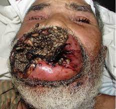 Cutaneous myiasis is a parasitic skin infestation caused by the larvae (maggots) of certain fly species. Oral And Maxillofacial Myiasis A Case Series And Literature Review Oral Surgery Oral Medicine Oral Pathology Oral Radiology And Endodontics