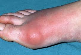 Image result for gout symptoms toe