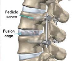 Low Cost Spinal Fusion Surgery In India 10 Most Affordable Spinal Fusion Hospitals In India