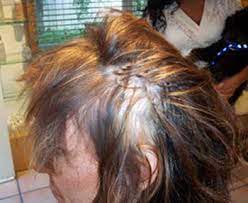 These can be placed throughout the hair near balding spots to mask the affected area. Us Doctor Warns On Traction Alopecia Hair Loss