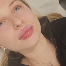 Facial Harmony 🖤 Such a pleasure to see this beautiful client today who  drove an hour to visit 🖤 We used 3.3ml to enhance the lips, chin and jaw.  Using small amounts