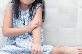 Biduran pada Anak Gejala Alergi Cuaca?