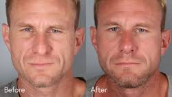 Facial Plastic Surgery