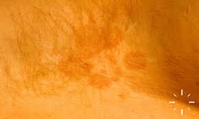 Image result for Erythrasma