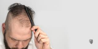 Yet as we've seen, there are many reasons to doubt that dht sensitivity is the sole cause of hair loss. My Hair Is Getting Thin What Should I Do Ahs India