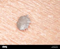 Image result for human scabies
