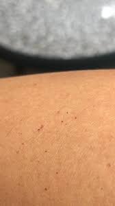 Ecchymosis is defined as hematomas large. Sind Das Petechien Rund Ums Baby