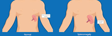 Splenomegalie Ursache Symptome Behandlung Mooci