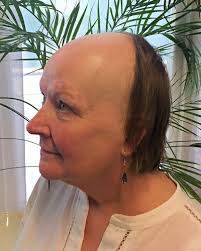 Jenny's Story of Frontl Fibrosing Alopecia