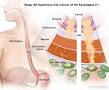 Image result for esophageal cancer silkworm