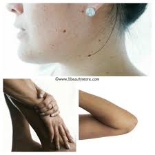 Hyperpigmentation Skin Discoloration And Natural Remedies blush beauty and more