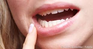 Wie genau sehen aphten im mund aus? Aphthen Ursachen Haufigkeit Und Tipps Netdoktor
