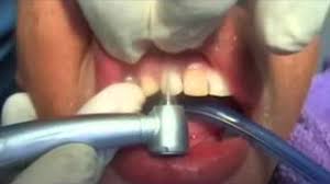 Harga atau biaya cukup beragam, di klinik bisa mencapai 2 jutaan sedangkan di puskesmas tentu akan lebih terjangkau lagi. Koleksi Kos Tanam Gigi Palsu Di Klinik Kerajaan Video Tips Xiaomi