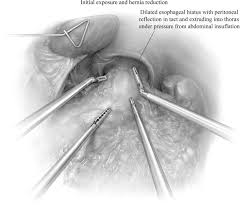 Image result for Hernia Reduction