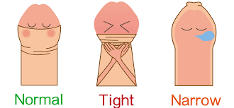 Image result for Phimosis