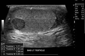 The echo pattern of testicular tissue adjacent to testis tumors was very irregular, with a score 4 in all tumor using a score from 1 (regular) to 5 (tumor pattern). Spermatogenesis Still Occurs In Men With Testicular Cancer Renal And Urology News