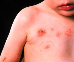 Medicii nu știu de ce unii oameni care au avut varicelă primesc zona zoster, iar alții nu. Herpesul Zoster La Copil Boli Infectioase