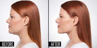 How A Dermatologist Can Eliminate Your Double Chin With An Injection Double Chin Double Chin Surgery Double Chin Removal