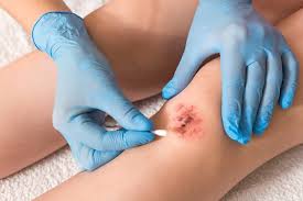 Wundbehandlung - terraplasma medical