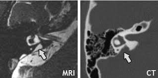 Enlarged Vestibular Aqueducts Eva Hearing Loss Nidcd