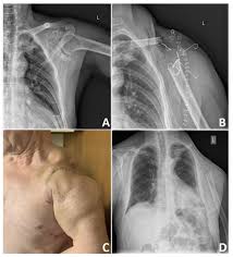 Image result for Chondrosarcoma