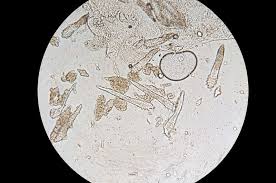 Image result for Demodex brevis