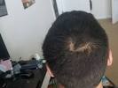 Crown Hair Loss Female