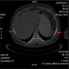 Abbreviations finder contains more than 7 million abbreviations and acronyms. Bone Loss In Obesity And Obstructive Sleep Apnea A Review Of Literature Journal Of Clinical Sleep Medicine