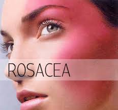 rosacea skincare advice fresh