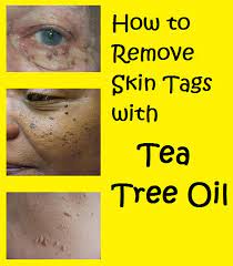 How To Remove Skin Tags With Tea Tree Oil Skin Tag Removal Skin Tag Oils For Skin