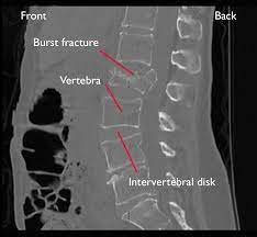 And finally build an application from scratch. Fractures Of The Thoracic And Lumbar Spine Orthoinfo Aaos