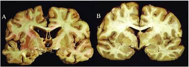 We will be using this. Coronal Slices Of Advanced Cte A Compared To A Normal Brain B Download Scientific Diagram