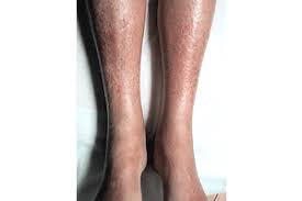 Kidney Disease 11 Ways It Can Affect Your Skin