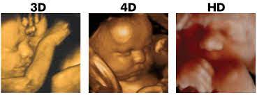 Frequently Asked Questions About 3d 4d Ultrasound Hd Ultrasound
