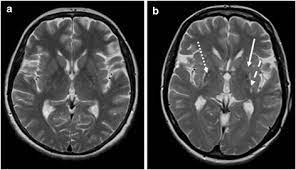 Structural Mri In Idiopathic Parkinson Disease And Parkinsonism Radiology Key