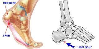 Bone spurs (especially on the foot) come about as a result of excessive pressure, stress, or rubbing of the area over prolonged periods. Heel Bone Spur Symptoms Causes Treatments Heel That Pain