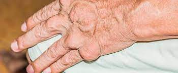 Wie Aussert Sich Gicht An Hand Und Finger