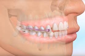 How many hours a day? Retainers Trommeter Orthodontics Denver Co