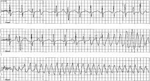 Image result for Loperamide Abuse