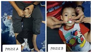 Selain itu, cara memberus gigi atau cara flos yang tidak betul, mengunyah tembakau, kemoterapi, perubahan hormon, dan kerengsaan dari perkakasan gigi juga boleh menjadi punca gusi bengkak. Dua Posisi Betul Berus Gigi Anak Menurut Pakar